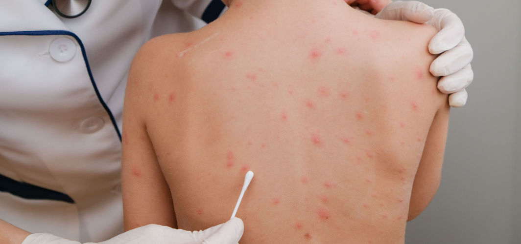 Chickenpox Diet: What To Eat And What Not To Eat