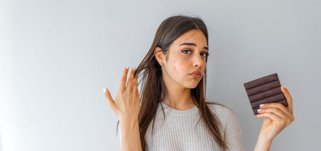 Can Your Diet Prevent Acne?