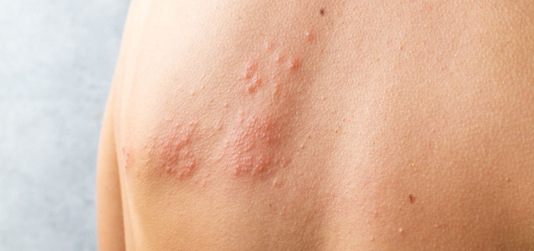 Everything You Need To Know About Shingles