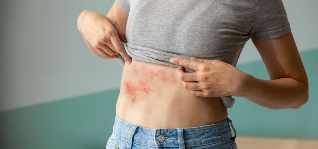 Shingles: Symptoms, Treatment, Vaccination