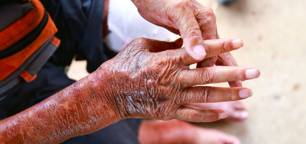 Scleroderma: Definition, Causes, Triggers, Symptoms, Treatments & Prevention