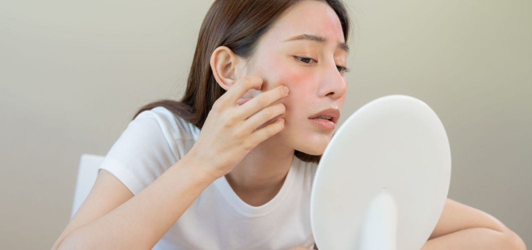 Rosacea Acne: Definition, Causes, Triggers, Symptoms, Treatments & Prevention