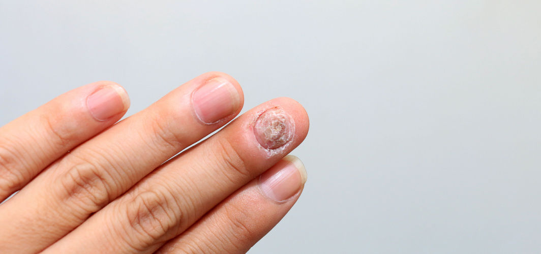 Pachyonychia Congenita: Causes, Triggers, Symptoms, Treatments & Prevention