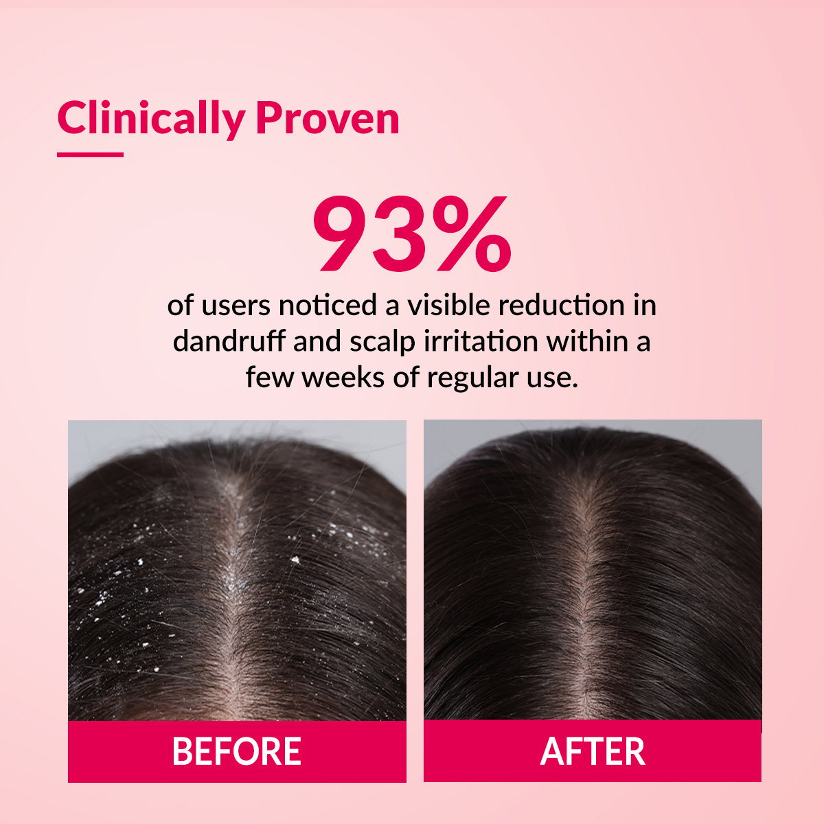 Fixderma Bioteez-S Shampoo, 75 ml, Pack of 1 Fixderma Bioteez-S Shampoo, 75 ml, Pack of 1