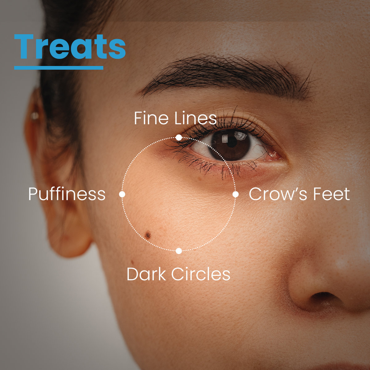 Fixderma Cosmetic Laboratories (FCL) Eye Refining Matrix Cream, 15 gm, Pack of 1 Fixderma Cosmetic Laboratories (FCL) Eye Refining Matrix Cream, 15 gm, Pack of 1