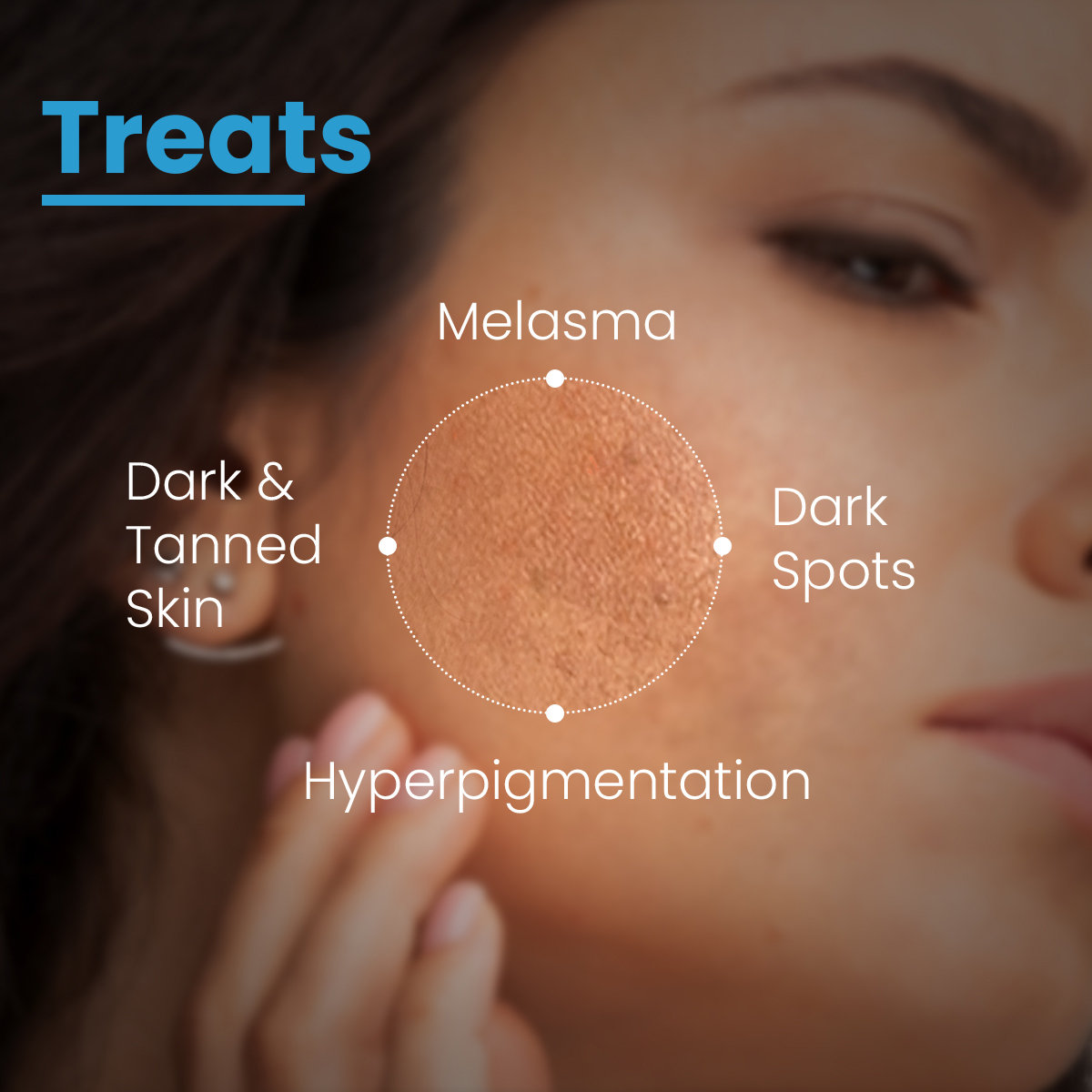 Fixderma Aha Lightening Gel, 30 ml, Pack of 1 Fixderma Aha Lightening Gel, 30 ml, Pack of 1