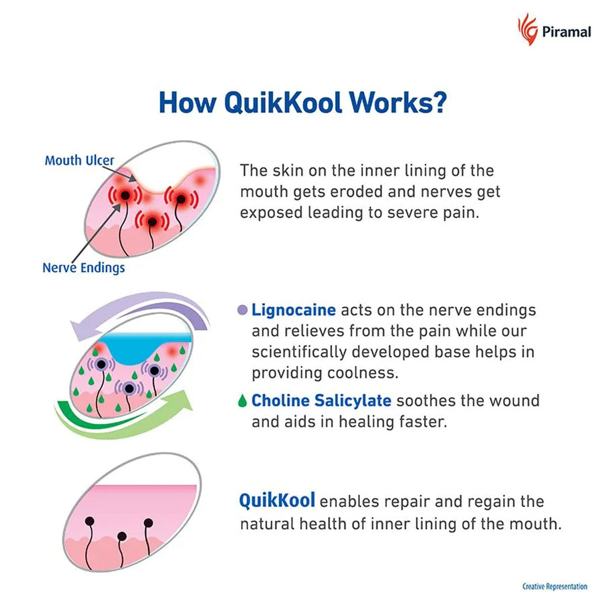 Quik Kool Mouth Ulcer Gel, 10 gm, Pack of 1 Quik Kool Mouth Ulcer Gel, 10 gm, Pack of 1