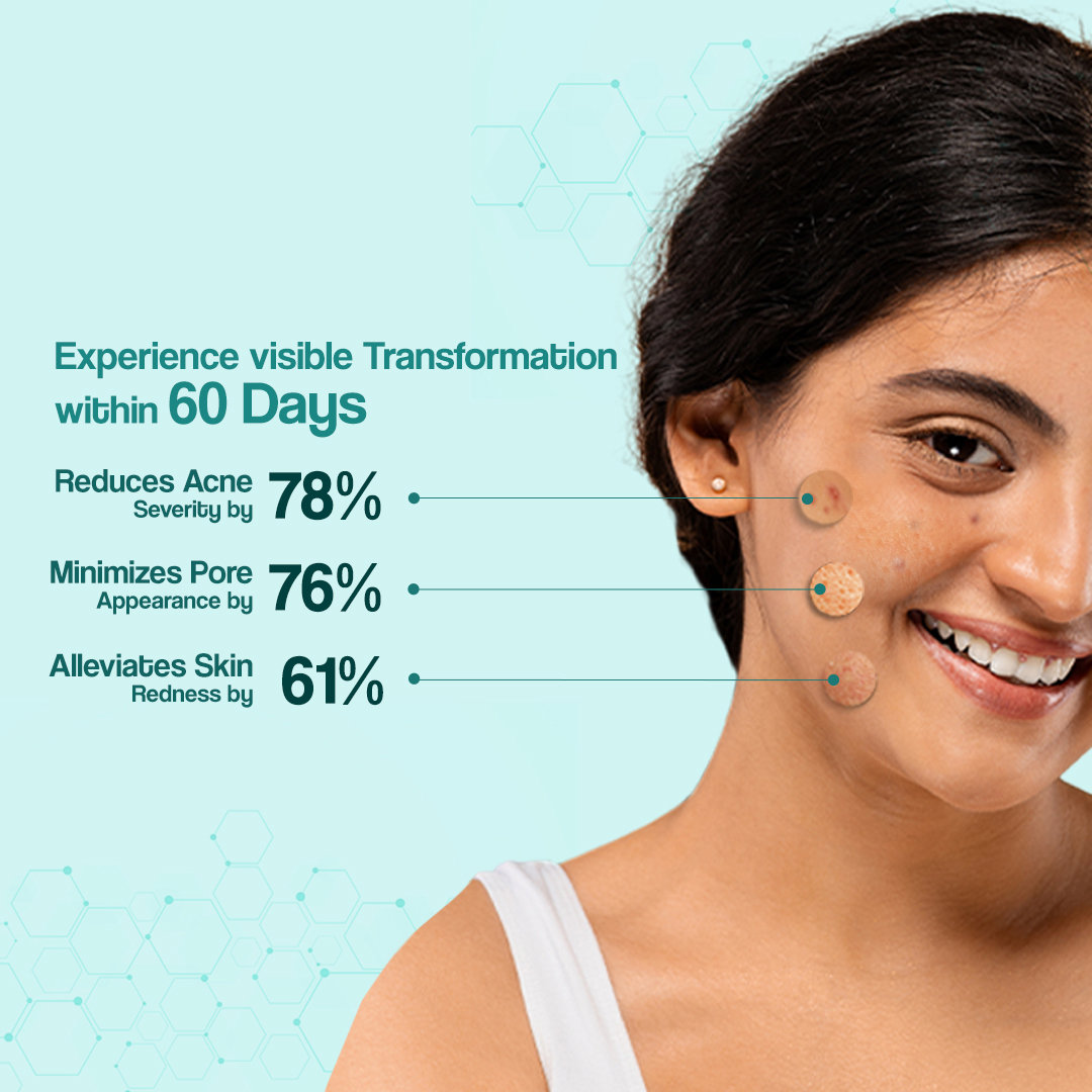 Venusia Acne Control Moisturizer Cream 75 gm, Pack of 1 Venusia Acne Control Moisturizer Cream 75 gm, Pack of 1