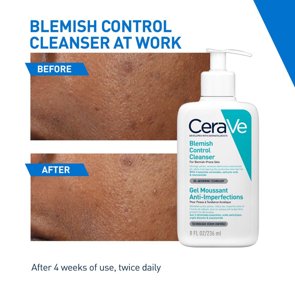 CeraVe Blemish Control Cleanser 236 ml | with 2% Salicylic Acid & Niacinamide for Acne-Prone Skin, Pack of 1 CeraVe Blemish Control Cleanser 236 ml | with 2% Salicylic Acid & Niacinamide for Acne-Prone Skin, Pack of 1