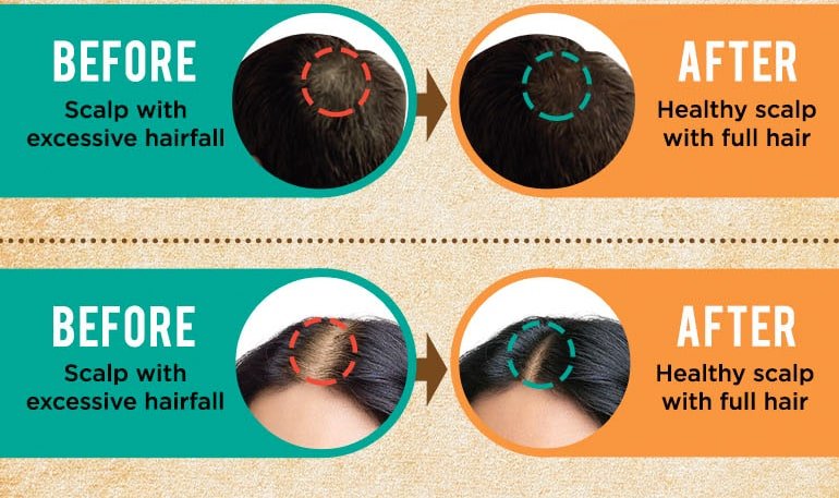 Indulekha Bringha Hair Oil, 100 ml, Pack of 1 Indulekha Bringha Hair Oil, 100 ml, Pack of 1