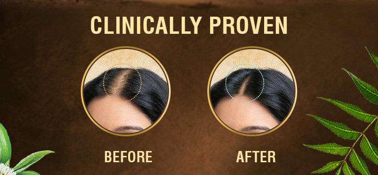 Indulekha Bringha Hair Oil, 100 ml, Pack of 1 Indulekha Bringha Hair Oil, 100 ml, Pack of 1