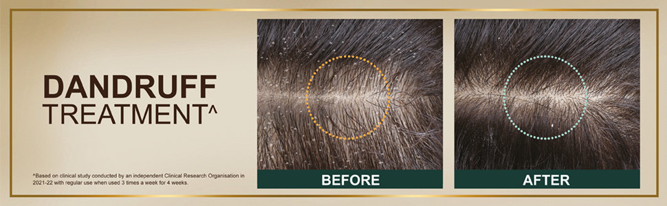 Indulekha Svetakutaja Oil for Dandruff Treatment, 100 ml, Pack of 1 Indulekha Svetakutaja Oil for Dandruff Treatment, 100 ml, Pack of 1