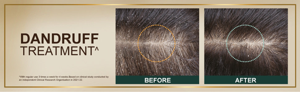 Indulekha Dandruff Treatment Shampoo, 200 ml, Pack of 1 Indulekha Dandruff Treatment Shampoo, 200 ml, Pack of 1