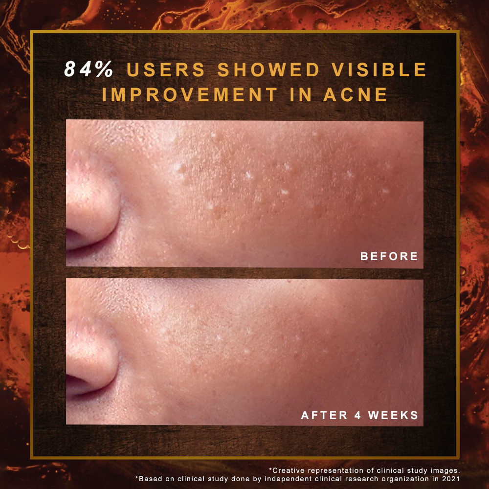 Indulekha Ayurvedic Proprietary Medicinal Soap 100 gm | Manjistha, Yashtimadhu, Matulunga, Laksha, Milk & Coconut Oil | For Dark Spots, Marks & Uneven Skin Tone, Pack of 1 Indulekha Ayurvedic Proprietary Medicinal Soap 100 gm | Manjistha, Yashtimadhu, Matulunga, Laksha, Milk & Coconut Oil | For Dark Spots, Marks & Uneven Skin Tone, Pack of 1