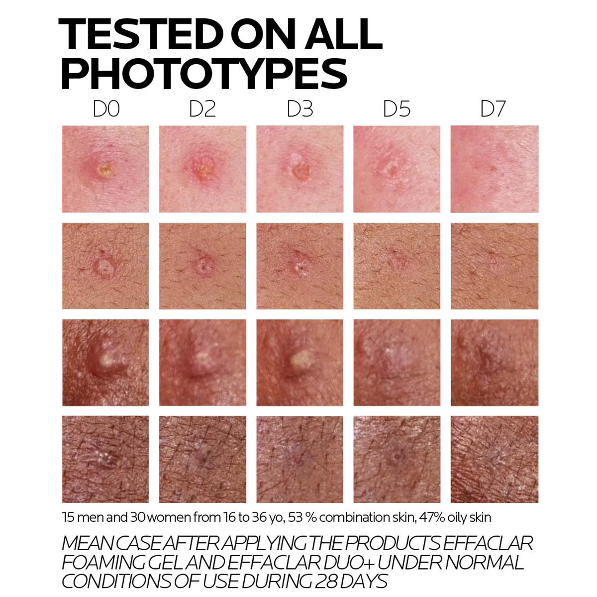 La Roche-Posay Effaclar Duo+M Gel Cream, 7.5 ml, Pack of 1 La Roche-Posay Effaclar Duo+M Gel Cream, 7.5 ml, Pack of 1