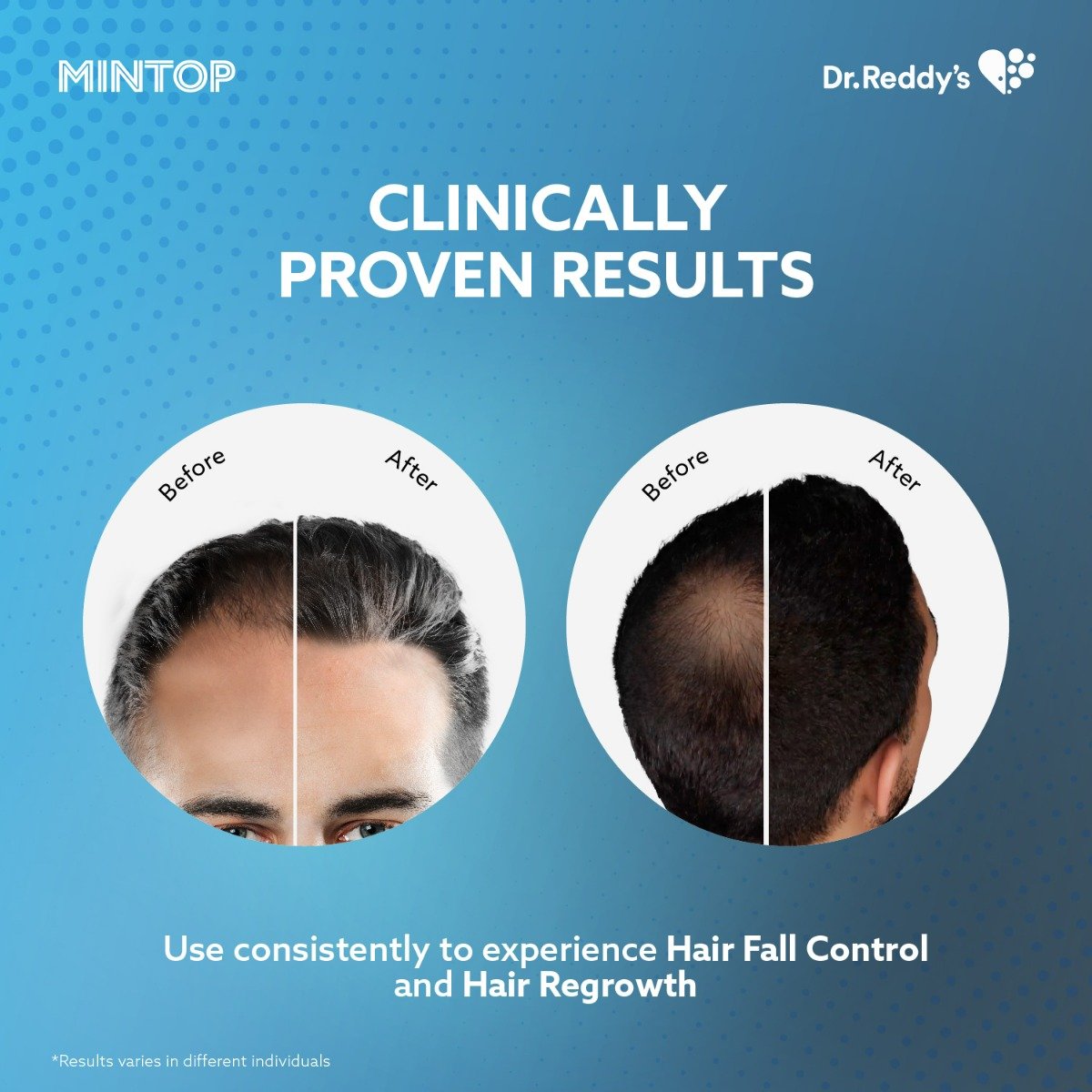 Mintop Forte 5% Solution, 60 ml, Pack of 1 Solution Mintop Forte 5% Solution, 60 ml, Pack of 1 Solution