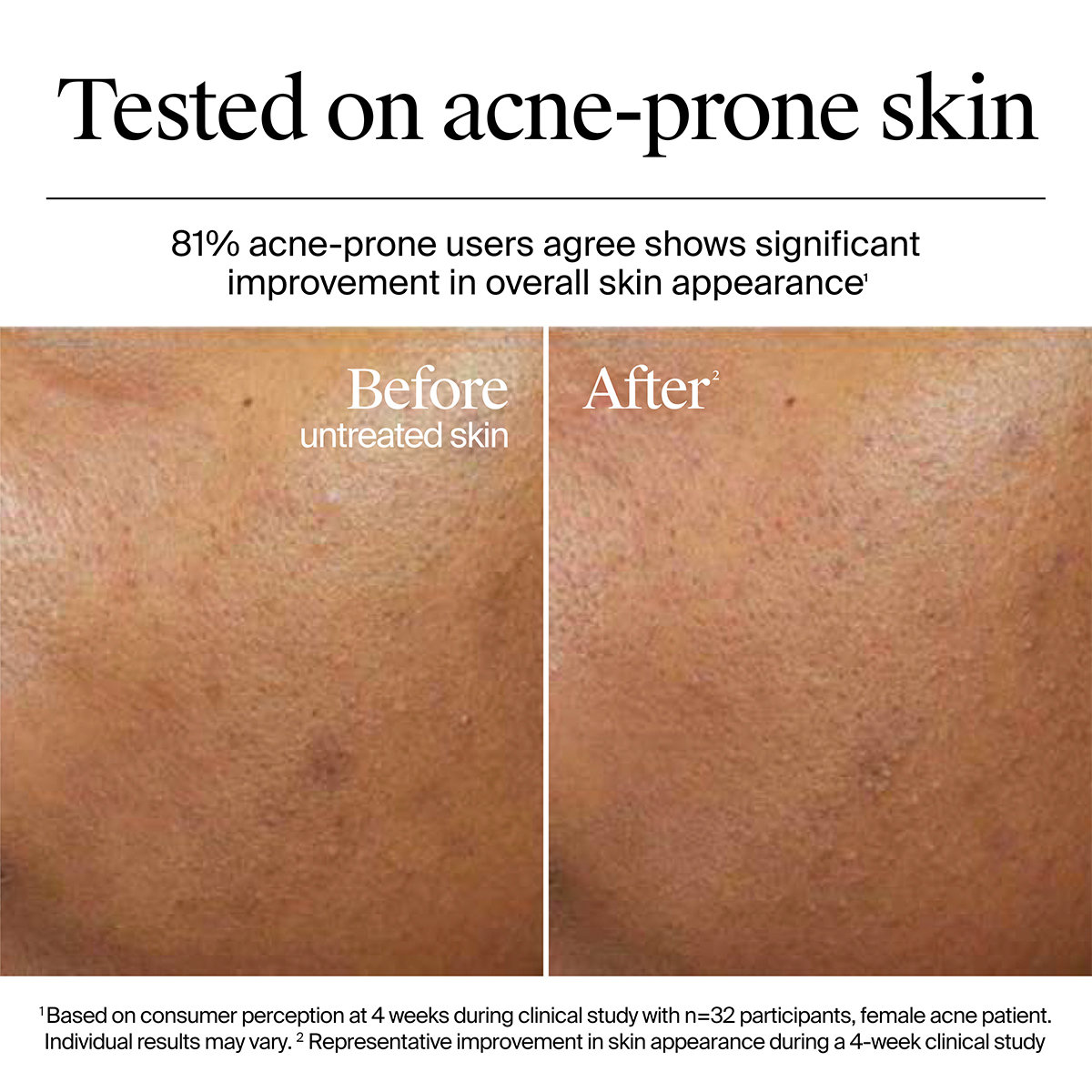 Neutrogena Hydro Boost Hyaluronic Acid Nourishing Cream, 50 gm, Pack of 1 Neutrogena Hydro Boost Hyaluronic Acid Nourishing Cream, 50 gm, Pack of 1