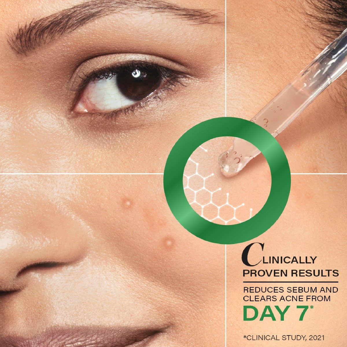 Novology Acne Clearing Serum, 28 ml, Pack of 1 Novology Acne Clearing Serum, 28 ml, Pack of 1