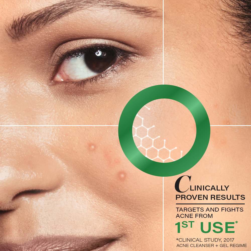 Novology Acne Rescue Spot Corrector, 30 gm, Pack of 1 Novology Acne Rescue Spot Corrector, 30 gm, Pack of 1