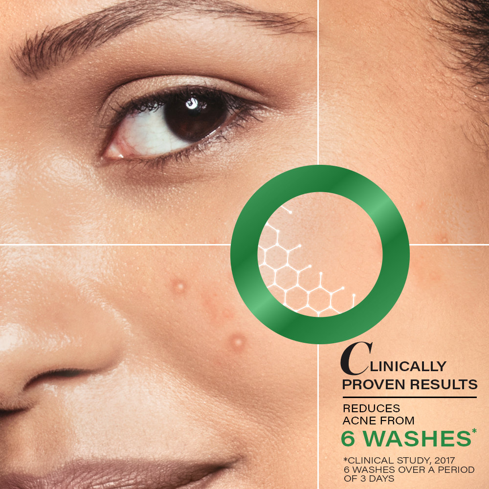 Novology Acne Deep Clearing Cleanser, 150 gm, Pack of 1 Novology Acne Deep Clearing Cleanser, 150 gm, Pack of 1