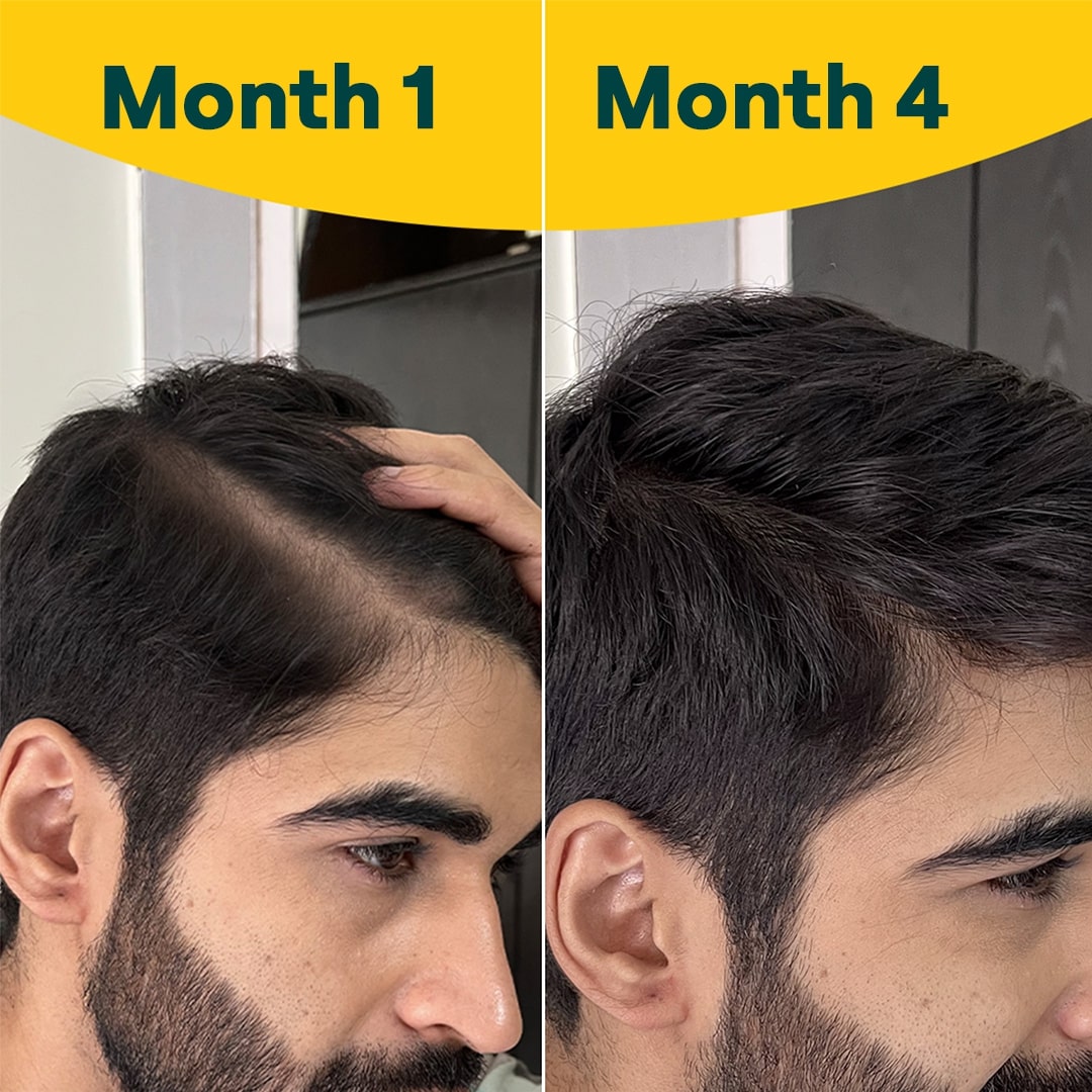 OZiva Hair Vitamins with Biotin, Vitamin E & Iron for Hair Re-growth & Hairfall Control, 60 Capsules, Pack of 1 OZiva Hair Vitamins with Biotin, Vitamin E & Iron for Hair Re-growth & Hairfall Control, 60 Capsules, Pack of 1