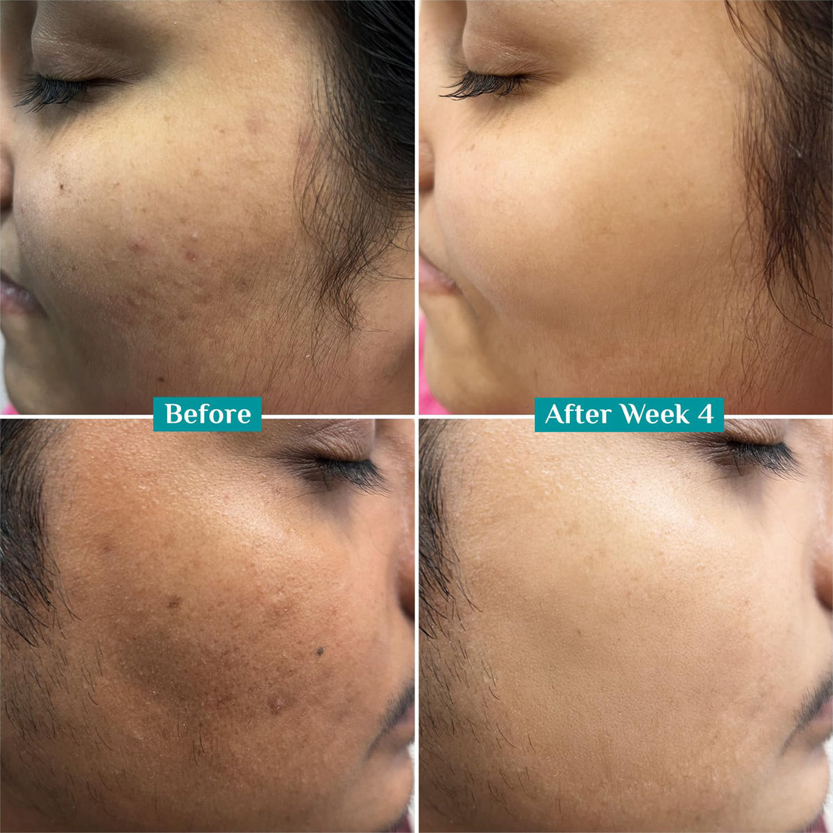 Pilgrim 10% Vitamin-C Face Serum, 10 ml, Pack of 1 Pilgrim 10% Vitamin-C Face Serum, 10 ml, Pack of 1