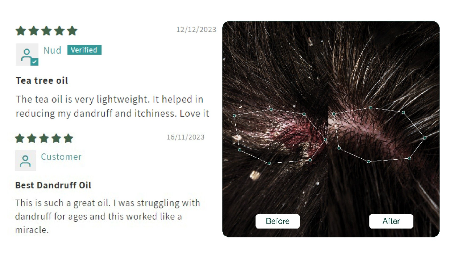 Soulflower Tea Tree Hair Oil for Dandruff & Itchy Scalp, 120 ml, Pack of 1 Soulflower Tea Tree Hair Oil for Dandruff & Itchy Scalp, 120 ml, Pack of 1