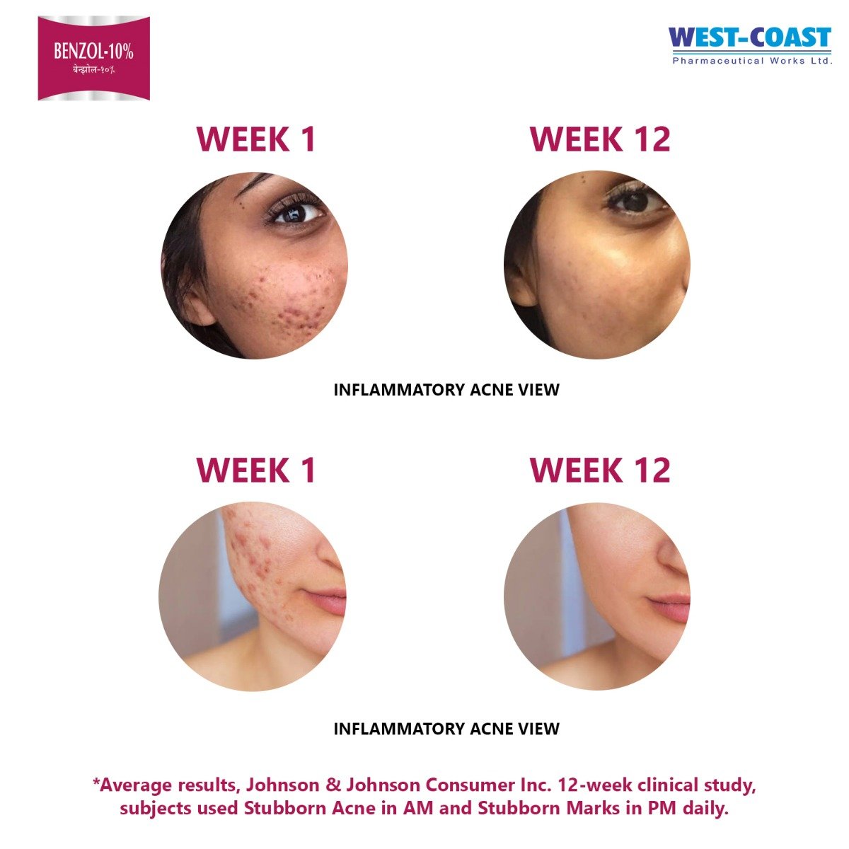 West-Coast Benzol-10% Face Wash 100 gm, Pack of 1 Face Wash West-Coast Benzol-10% Face Wash 100 gm, Pack of 1 Face Wash