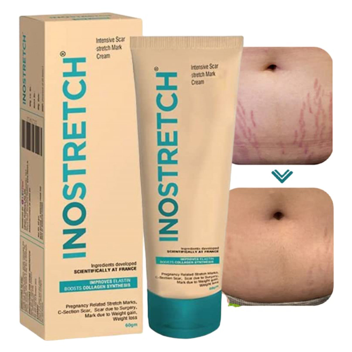 Inostretch Cream 60 gm, Pack of 1 Inostretch Cream 60 gm, Pack of 1