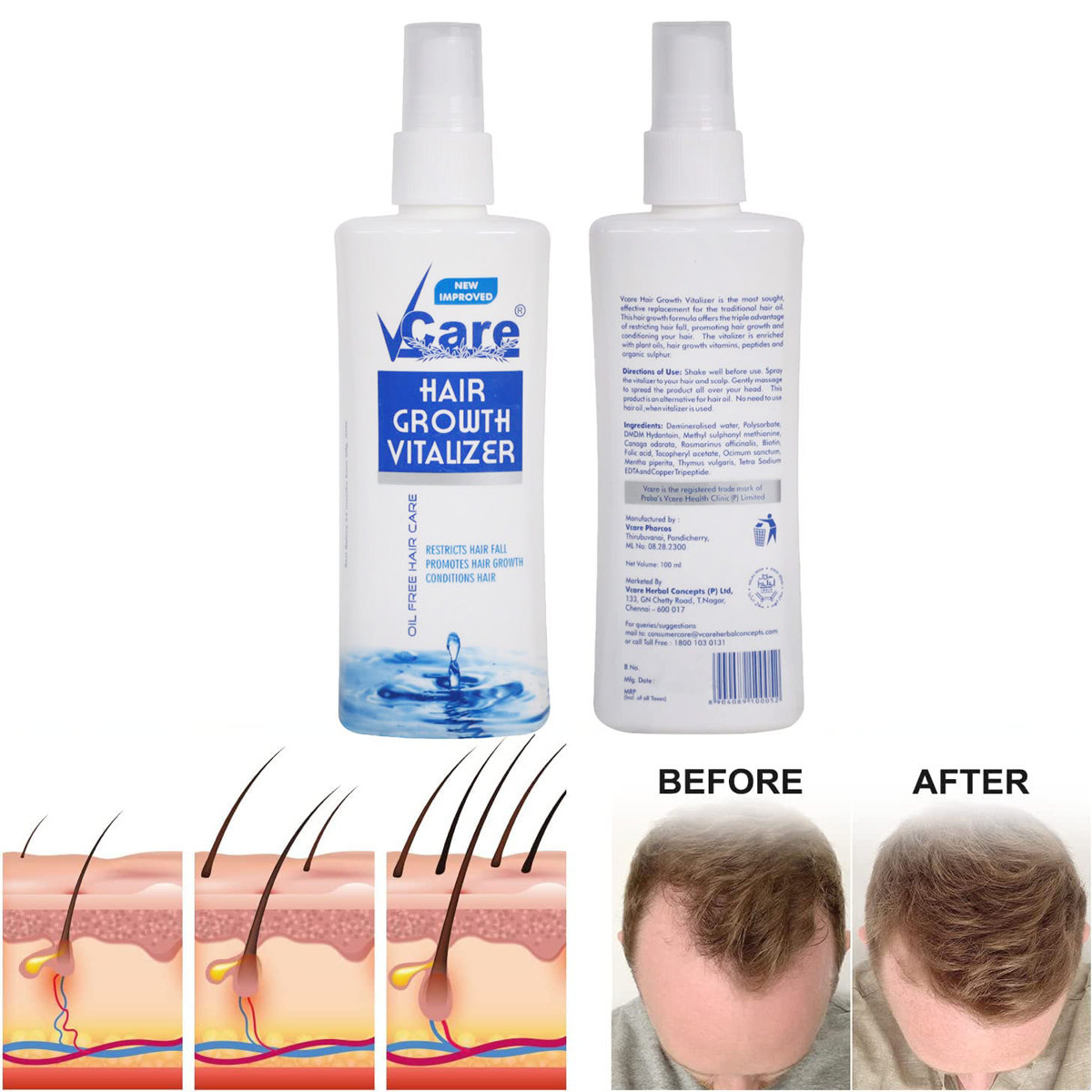 V-Care Hair Growth Vitalizer, 100 ml, Pack of 1 V-Care Hair Growth Vitalizer, 100 ml, Pack of 1